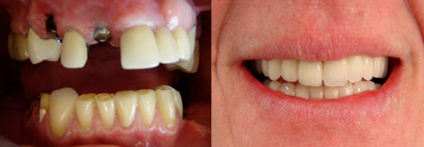 WHAT IS THE PROCESS FOR A FULL MOUTH RESTORATION?