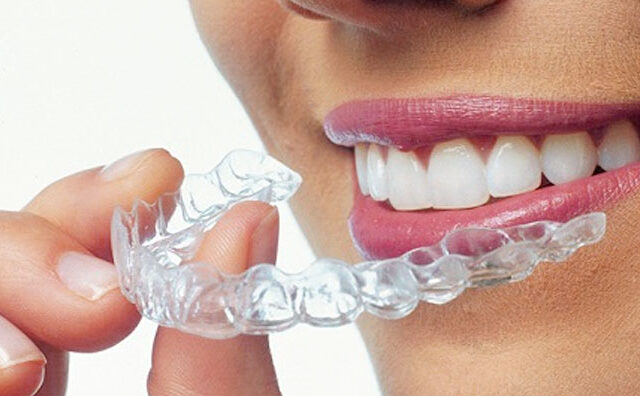 WHAT ARE THE BENEFITS OF INVISALIGN?