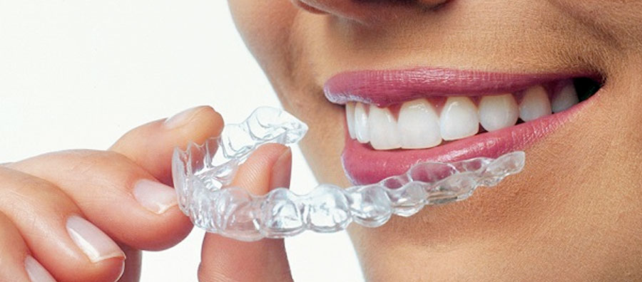 WHAT ARE THE BENEFITS OF INVISALIGN?