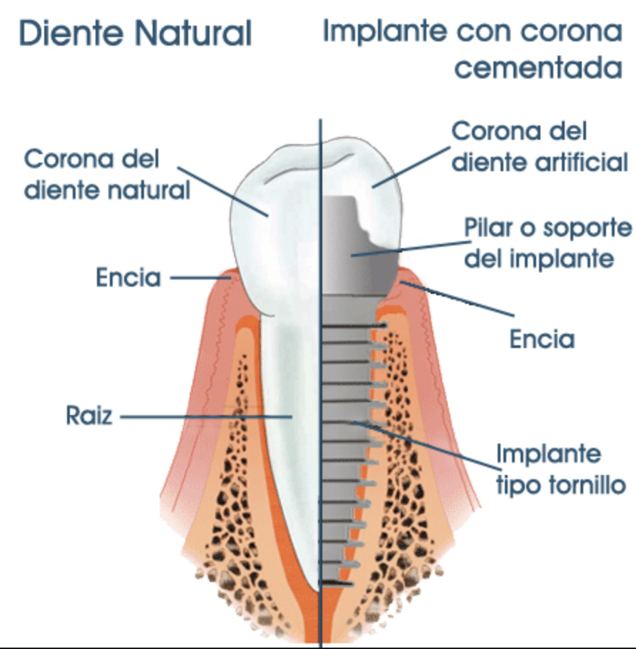 Distintas partes de un implante dental en costa rica