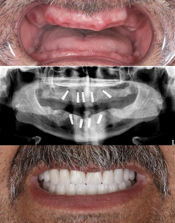 Full-Mouth-Reconstruction-confidental-costa-rica-1 (1) https://confidentalcr.com/wp-content/uploads/2026/03/Full-Mouth-Reconstruction-confidental-costa-rica-1-1.jpg