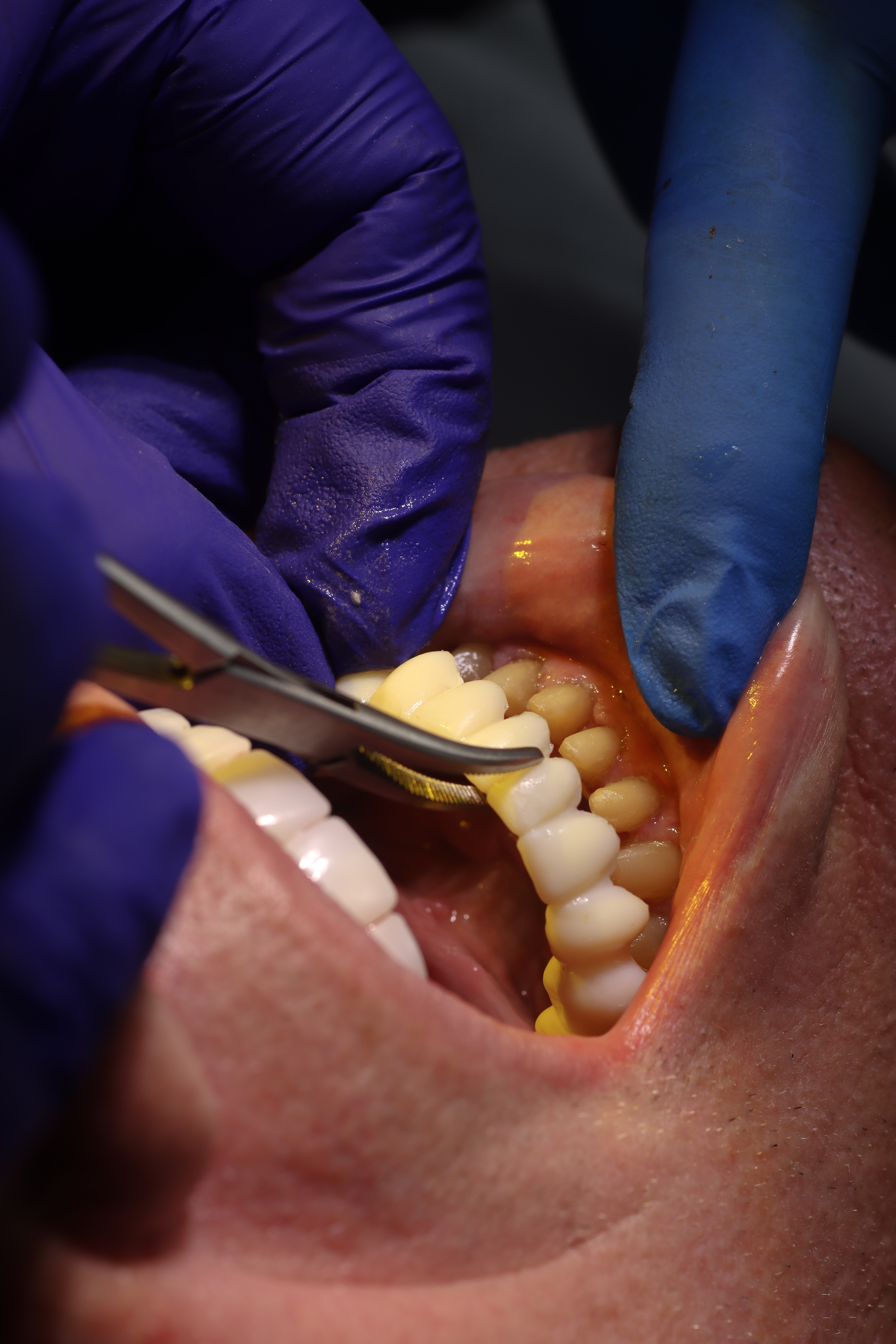 Dental Implant Brand and Material Quality: What Every Patient Should Know Before Choosing a Clinic